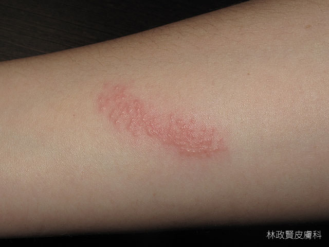 水母皮膚炎，jellyfish dermatitis