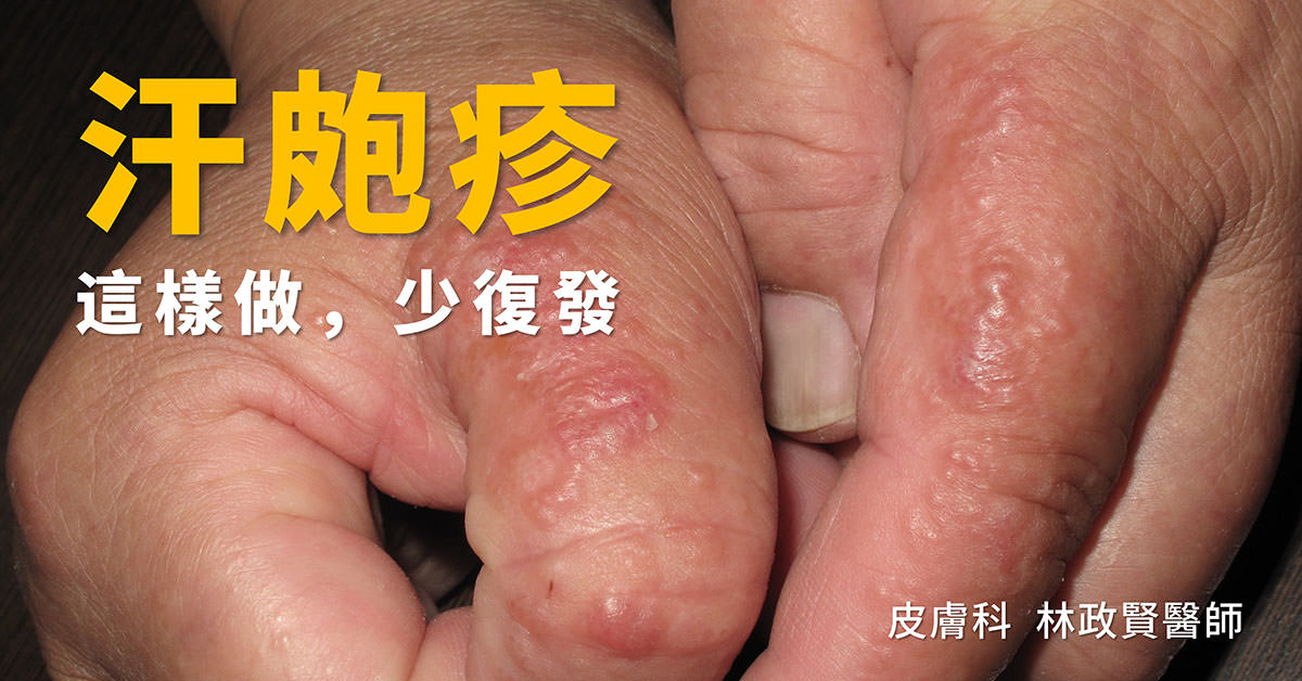 汗皰疹,汗疱疹,pompholyx,dyshidrotic eczema,手部濕疹,富貴手